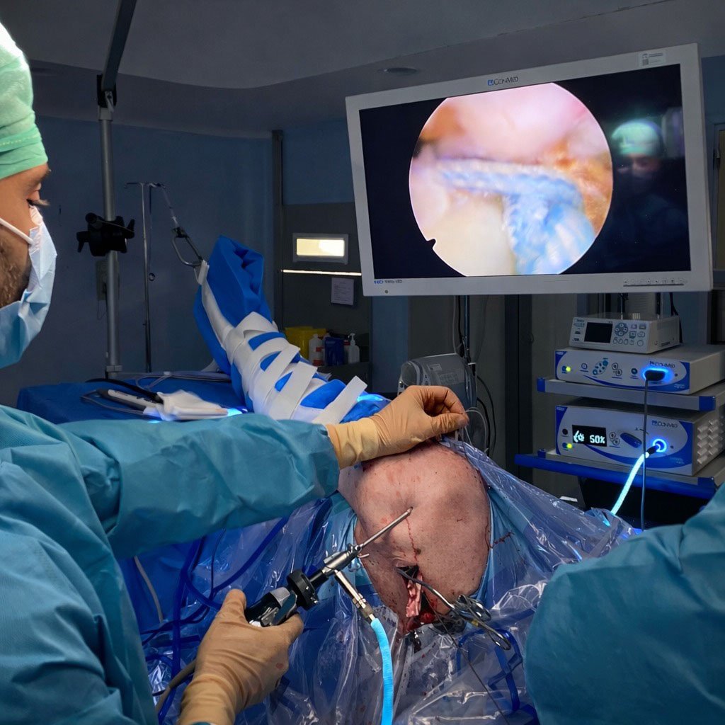 Intervención quirúrgica para mejorar un manguito rotador roto.